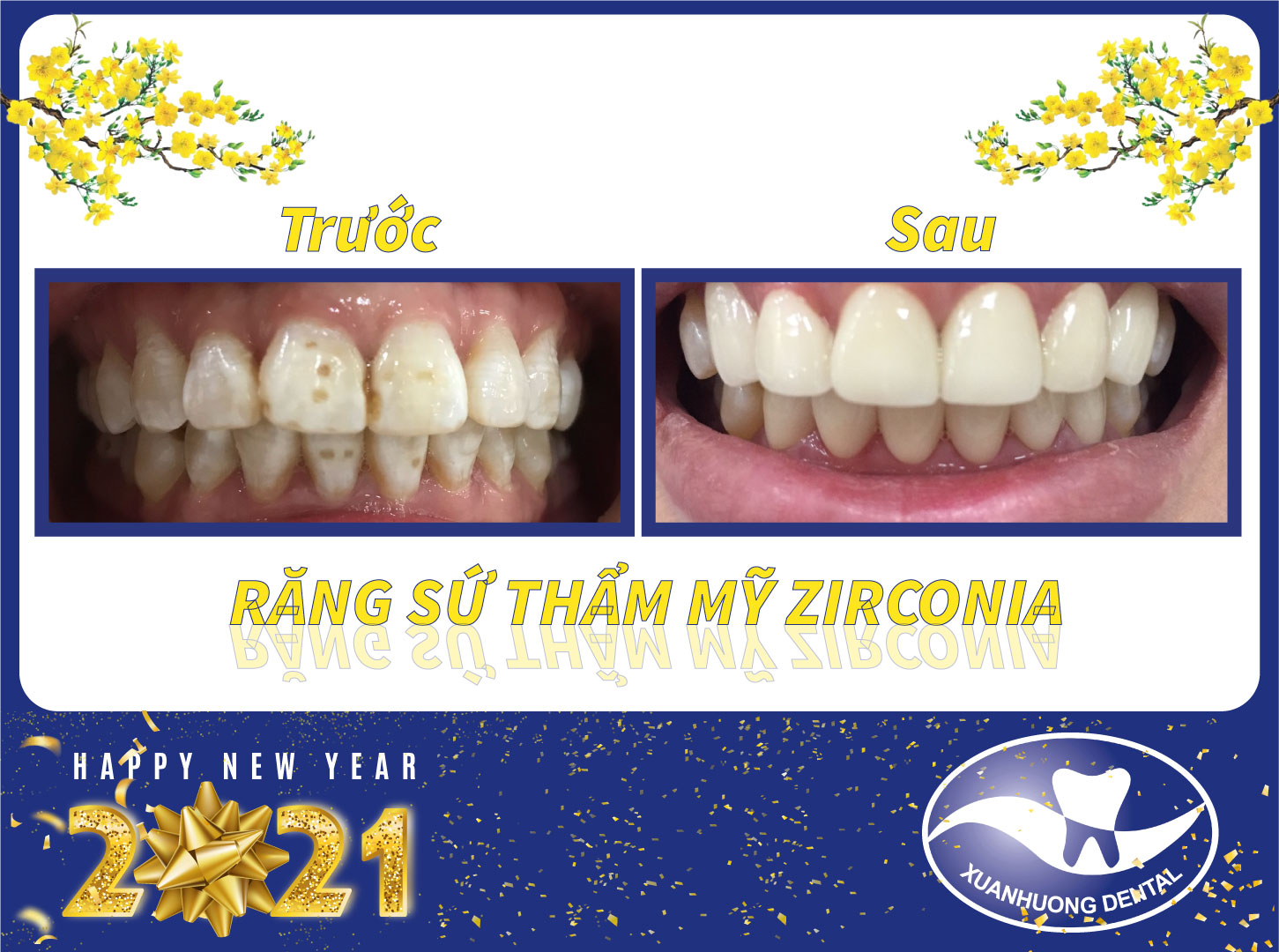 Phục hình răng sứ trả góp 0% lãi suất tại thành phố Buôn Ma Thuột